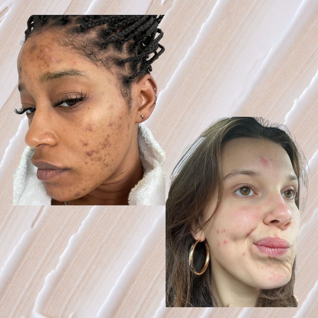 All Of Your Burning Questions About Adult Acne, Answered